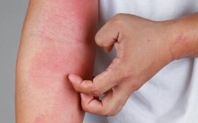 Dermatite Atópica em crianças: o que os pais precisam saber em 2025