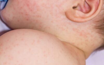 Alergia alimentar x intolerância alimentar: qual a diferença?
